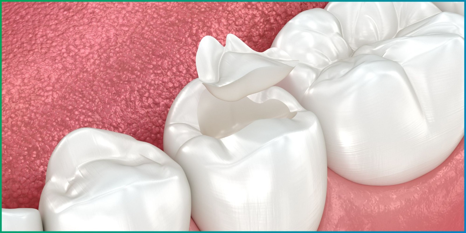 Dental Crowns Enhance Your Smile